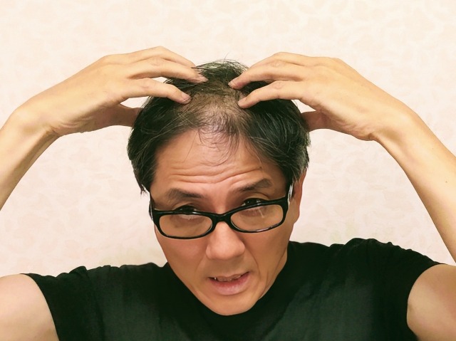 AGAにみられる特徴的な変化