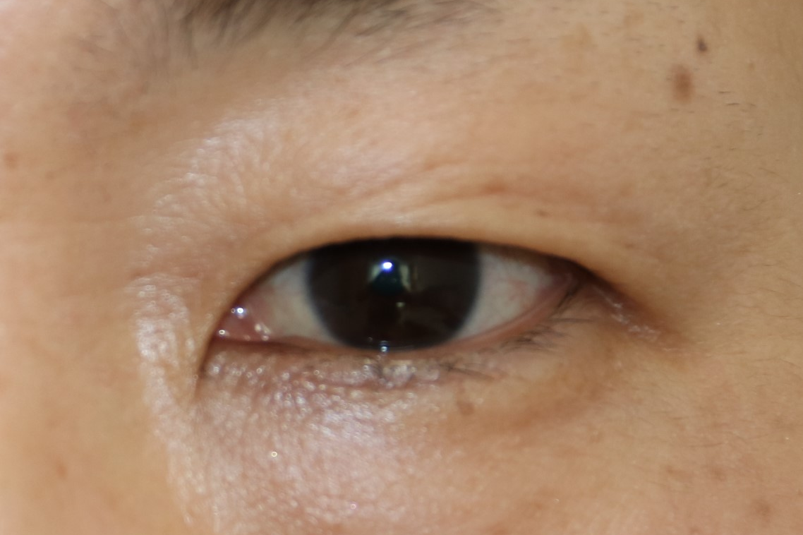 眼瞼下垂とは